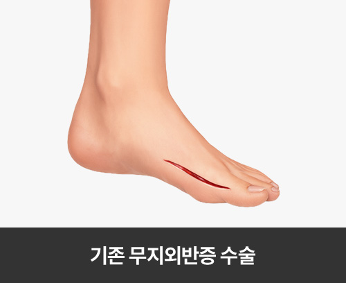 기존 무지외반증 수술